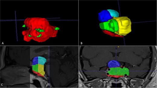Manual planimetric volumetric segmentation. (A) Calculation of total tumor volume (red) and its relationship with the internal carotid artery (green). (B) Volumetry by zones. (C and D) Areas shown in sagittal and coronal planimetry.