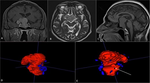 (A, B and C) MRI of pituitary marcoadenoma in coronal, axial and sagittal sections, contrasted T1, T2, and T1 sequences. (D and E) Planimetric segmentation with 3D reconstruction of the basilar and carotid system. White arrow, relationship of the dorsum of the tumor with the basilar artery.