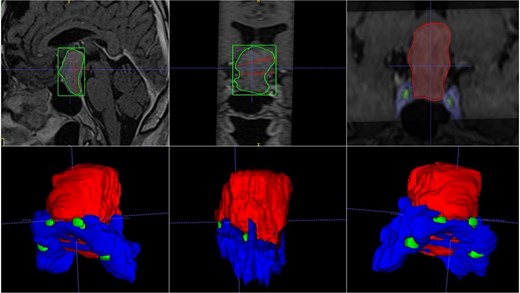MRI and 3D volumetric segmentation of pituitary macroadenoma. Note the proximity of the internal carotid artery (green) in the most rostral and dorsal region of the tumor (red). Cavernous sinus (blue).