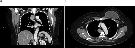 CT thorax revealing a 4.1 × 3.3 cm azygos vein aneurysm. a) Coronal view. b) Transverse view.