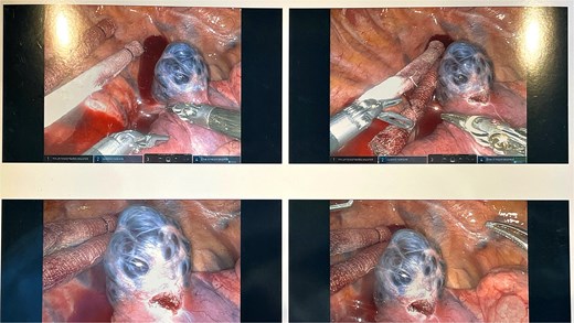The intra-operative findings included a hemorrhagic multi-cystic appearing lesion which was connected to the azygos vein as well as the apex of the right lung.