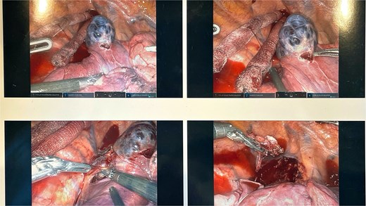 This lesion was isolated with electrocautery and blunt dissection; proximal and distal control of the azygos vein were transected with a surgical stapler.