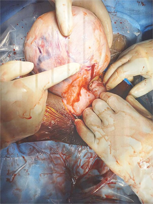 Predunculated fibroid with overlying bleeding vessels.