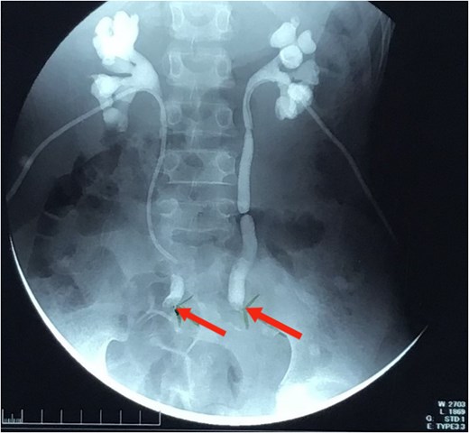 Nephrostogram showing bilateral hydroureter with complete ureteric obstruction and no dye in the bladder. The two arrows indicate complete bilateral ureterovesical obstruction.