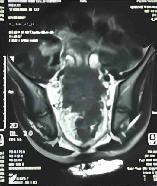 MRI sagittal view showing the tumor extending from the rectosigmoid to the upper and middle rectum, with mesorectal lymph nodes and extramural venous invasion.
