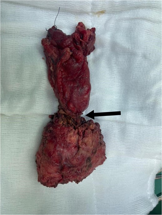 Total mesorectal excision (TME) specimen, with arrow pointing to the tumor.