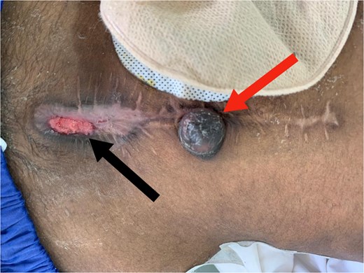 Red arrow: Sister Mary Joseph nodule. Black arrow: Wound dehiscence at the lower edge of the midline incision.