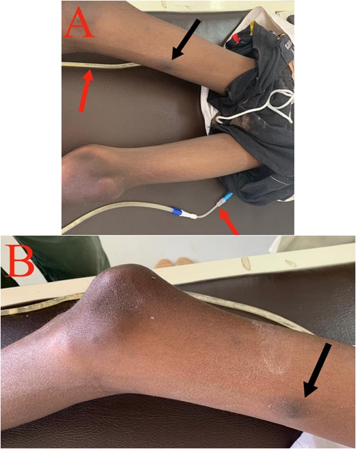 Cutaneous metastasis: (A) Black arrow: cutaneous nodule on the medial aspect of the right thigh. Red arrow: right and left nephrostomy tubes. (B) Black arrow: cutaneous nodule on the medial aspect of the right thigh.