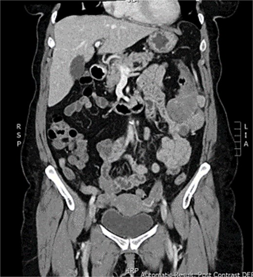 CT abomen + pelvis with contrast demonstrating ~5 × 5 cm exophytic lobulated mass at splenic flexure, appearing to arise from transverse colon.