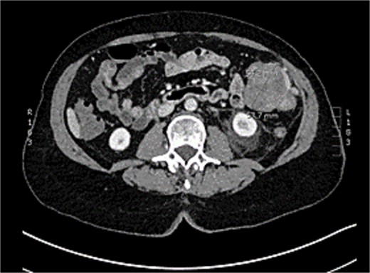 CT abomen + pelvis with contrast demonstrating ~5 × 5 cm exophytic lobulated mass at splenic flexure, appearing to arise from transverse colon.