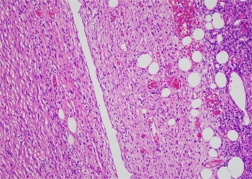 Low-grade component with spindle cells with tapered nuclei and indistinct cytoplasm that merges into a delicate collagenous stroma.
