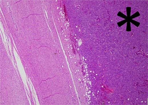 Low-grade component with abrupt transition to high-grade component (asterisk).
