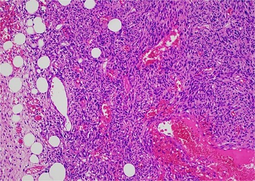 The high-grade component demonstrates increased cellularity, hyperchromasia and moderate to marked pleomorphism including scattered multinucleate cells.