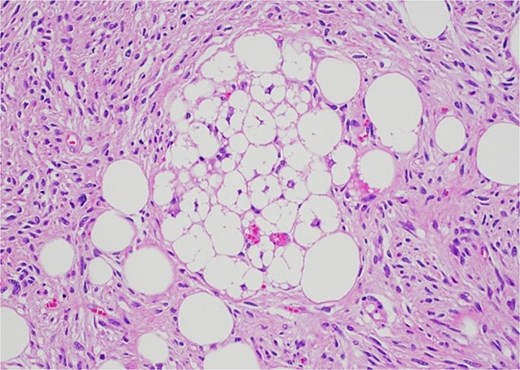The lesion contained a single of lipoblasts.