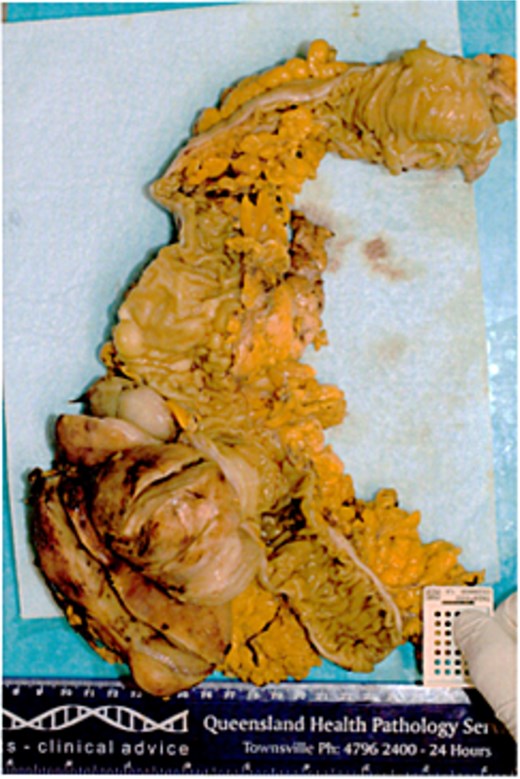 Macroscopic pictures of resected transverse colon with tumour.