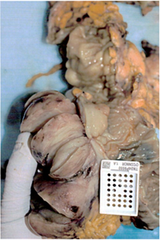 Macroscopic pictures of resected transverse colon with tumour.