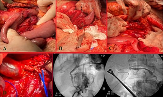 Index operation. A: Transverse colon hematoma. B: Duodenal (D2) injury. C: Pancreatic head and tail vascular injury. D: Common bile duct and intraoperative cholangiogram through the common bile duct and cystic duct.