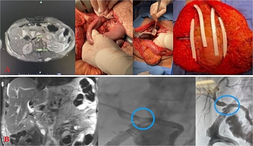 Injury sequelae and interventions. A: Re-exploration due to bilious changes. B: Delayed presentation of common hepatic duct stricture with rendezvous procedure.