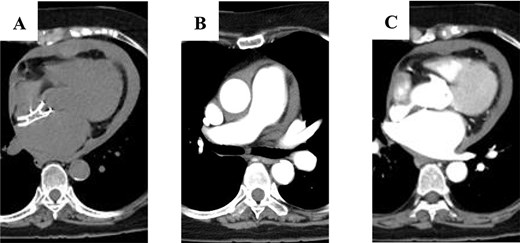 Computed tomography scan showing: (A) circumferential pericardial effusion; (B) no aortic dissection; and (C) no extravascular leakage of contrast media.
