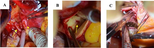 Surgical findings: (A) part of the device extruding from the right atrium (arrow) and a pinhole perforation on the aortic wall (dotted arrow); (B) perforation only without intimal injury inside the aorta; and (C) removal of the device.