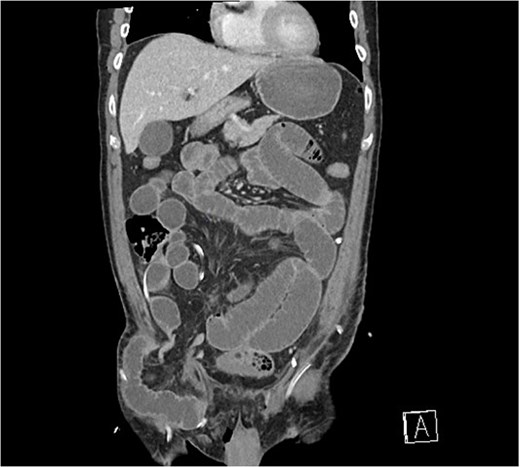 Coronal CT scan demonstrating small bowel herniating below the inguinal ligament, lateral to femoral vessels.