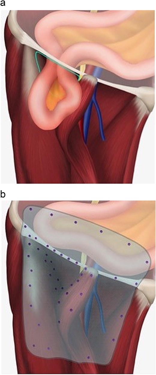 (a) Illustration demonstrating location of incarcerated hernia in relation to femoral vessels. Sartorius muscle has been transposed from anterior superior iliac spine insertion to the midpoint of the inguinal ligament to protect the femoral vessels. (b) Illustration of mesh repair and schematic placement of tacks.