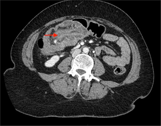 Contrast enhanced CT of the abdomen showing bull’s eye sign (arrow) suggestive of ileocolic intussusception.