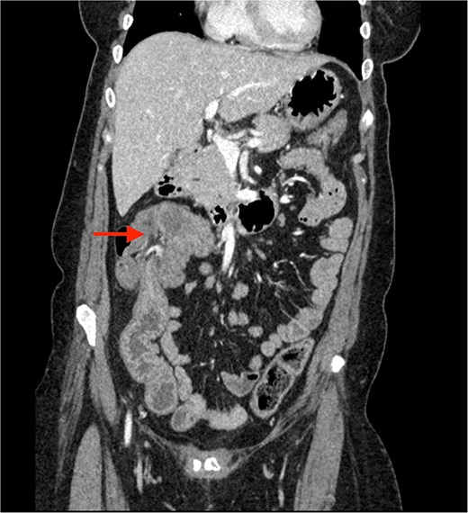Contrast enhanced CT of the abdomen showing an arrow pointing to the region of ileocolic intussusception.