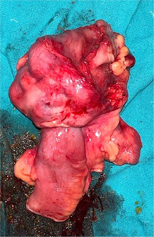 Section of resected specimen showing telescoping of distal ileum into cecum due to a lobulated mass.
