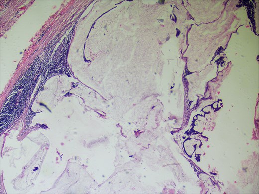 Hemotoxylin and eosin ×100: Section shows atypical cells floating in lates of extra cellular mucin.