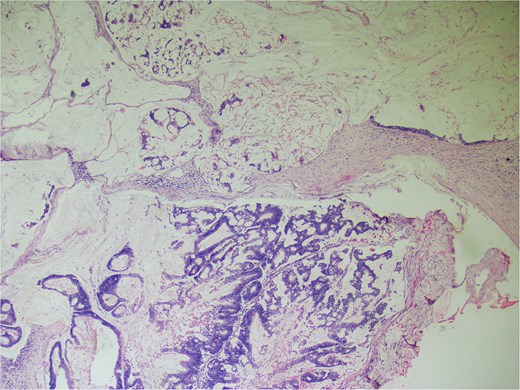 Hematoxylin and eosin ×40: Section shows lymph node effacement of by pool of mucin and few atypical cells and the periphery show compressed lymphoid tissue.