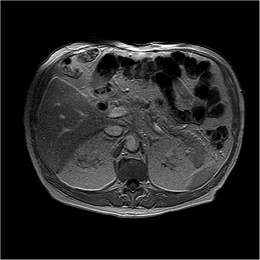 T1-weighted MRI illustrating a hypointense nodular lesion in the pancreatic tail, measuring 24 × 20 mm. The lesion demonstrates restricted diffusion and delayed contrast enhancement, consistent with a neoplastic process suggestive of malignancy.