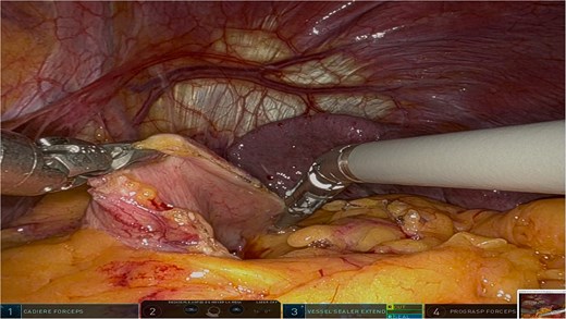 Intraoperative view showcasing the dissection and mobilization of the greater curvature of the stomach. This involved dividing the gastrocolic ligament to expose the retroperitoneal space, providing access to the distal pancreas while preserving surrounding structures to minimize surgical trauma.