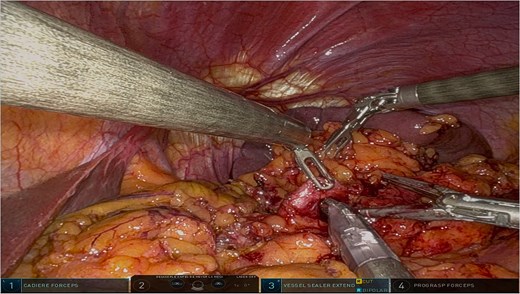 Intraoperative image highlighting the robotic ligation of the splenic artery. The Da Vinci system facilitated precise dissection and secure vascular control, minimizing blood loss and ensuring the preservation of adjacent structures, such as the splenic vein. This step was critical for the safe resection of the distal pancreas and spleen.