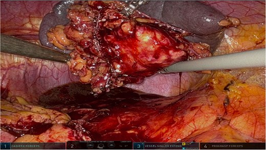 Complete surgical specimen, including the distal pancreas and spleen, shown after extraction via a mini-laparotomy. The specimen demonstrates clear resection margins, achieved through robotic precision, highlighting the effectiveness of the surgical approach.
