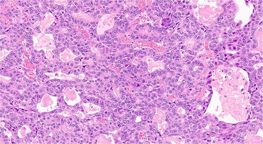 Histopathological slide showing well-differentiated acinar cell carcinoma with eosinophilic cytoplasm, monomorphic nuclei, and zymogen granules (hematoxilina-eosina staining, ×20 magnification).