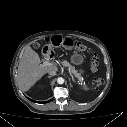 Postoperative CT scan showing surgical clips in the pancreatic tail region and a hypodense nodular lesion with lipomatous characteristics, measuring 2.1 cm, adjacent to the surgical site. No evidence of recurrence or complications is observed.