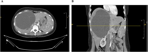 CT scan of the abdomen: Demonstrating the hepatic mass measuring involving the segments 4A, 4B, 5, 6, and 8. A) Transverse view, B) longitudinal view.