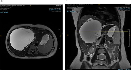 MRI of the liver: Demonstrating the mass in T2. Mild splenomegaly was noted without focal lesions. A) Transverse view, B) longitudinal view.