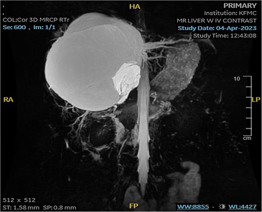 MRI of the liver: Demonstrating smaller bright T2 signal intensity lesions without post-contrast enhancement were observed in segment 7 and segment 6, consistent with cysts.