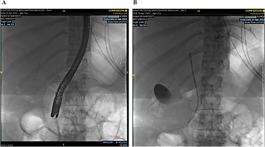 Endoscopic retrograde cholangiopancreatography (ERCP): Demonstrating the cannulation procedure and the placement of the cannula.