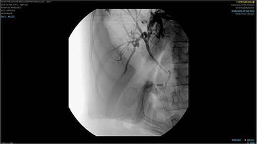 Demonstrating placement of a plastic stent in the right hepatic duct and ventral pancreatic duct as post-ERCP prophylaxis.