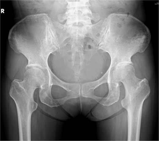Pelvic radiograph of a 44-year-old female showing symmetric left hip joint space narrowing, indicative of hip septic arthritis.