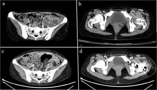 Computed tomography of a 44-year-old female demonstrating (a) a psoas abscess and (b) hip septic arthritis. Postdebridement surgery and resection arthroplasty, the abscess completely resolved (c, d).