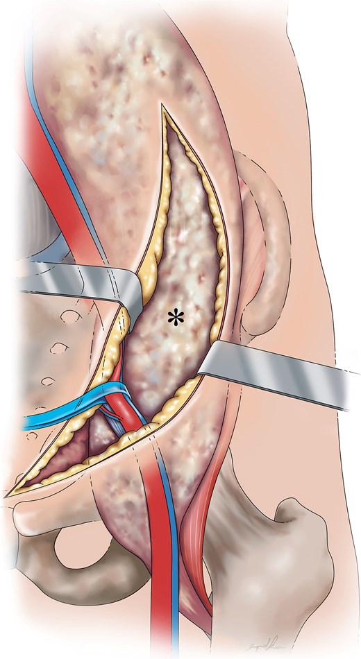 Graphical depiction of a psoas abscess (*) following dissection from the abdominal wall, fascia layers (Camper’s and Scarpa’s fascia), external oblique aponeurosis, and transversalis fascia with medial retraction of the external iliac vessels.