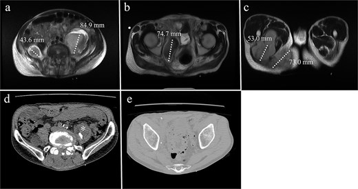 MRI of a 68-year-old male with (a) bilateral psoas abscesses (right: 43.6 mm, left: 84.9 mm). The right abscess extended caudally to (b) the quadrilateral plate of the acetabulum and (c) the medial thigh and ischial tuberosity region. (d) Partial resolution of the right abscess with persistence of the left abscess (*). (e) Complete resolution of the right caudal extension after debridement.