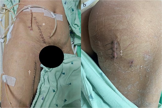 Surgical incisions: (a) pararectus incision (*) and medial thigh incision (†). (b) Skin incision (‡) for ischial tuberosity abscess drainage.