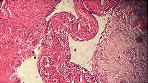 Histopathological examination showing cystic cavities of varying sizes lined by flattened endothelium.
