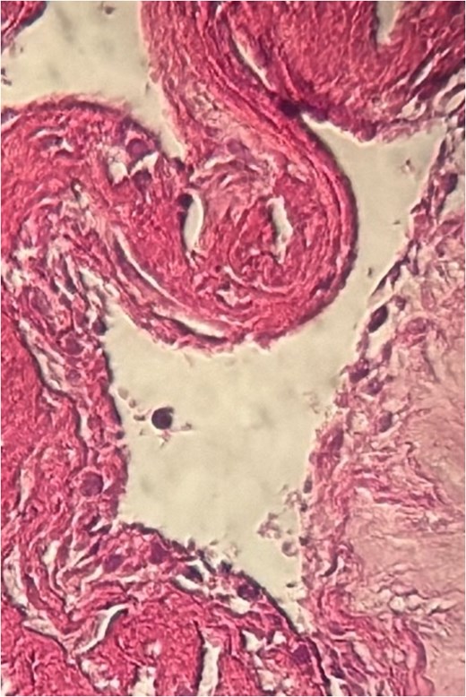 Eosinophilic material and inflammatory infiltrates composed of lymphocytes and red blood cells.