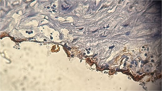 Immunohistochemical staining showing positivity for podoplanin/D2–40, confirming the lymphatic origin of the lesion.